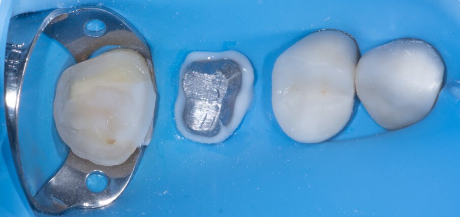 Fig. 9: A wide operatory field facilitated the cementation procedure.