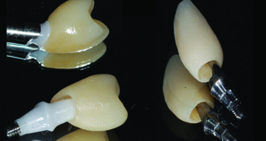 Funkcionalno estetska rehabilitacija  ortodontske anomalije minimalno invazivnim postupkom - timski pristup