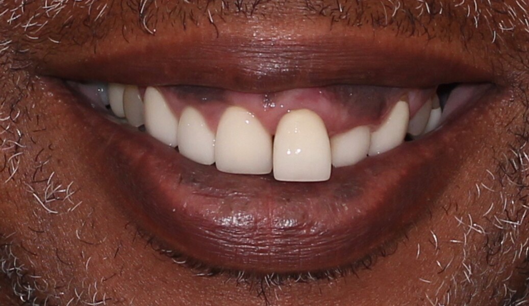 Fig. 2: Frontal view of the patient’s smile.