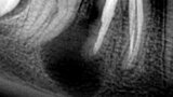 Figura 2. Lesión periapical en el diente 46 (primer molar inferior derecho) de gran tamaño. Iniciando una reabsorción radicular externa en la raíz distal.