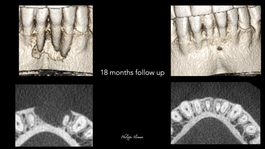 Slike 8a–d: Poređenje kostiju i horizontalnih prikaza preoperativnog (a i b) i 18-mesečnog praćenja i-CAT skeniranja (c & d) u vezi sa zarastanjem kosti i zatvaranjem džepa
