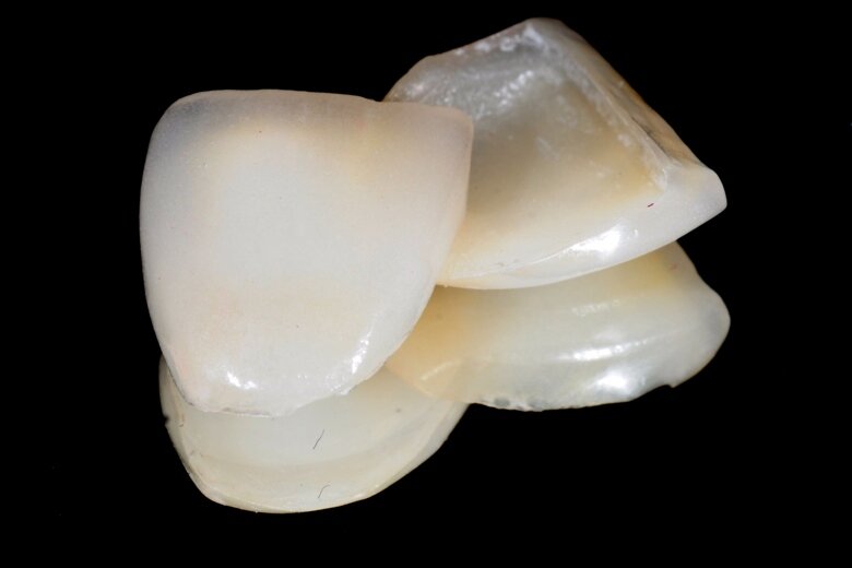 Fig. 11 The veneers constructed by the dental technician.