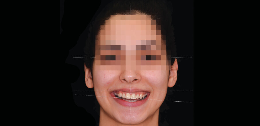 Slika 4. Pomoćne ravnine za analizu lica