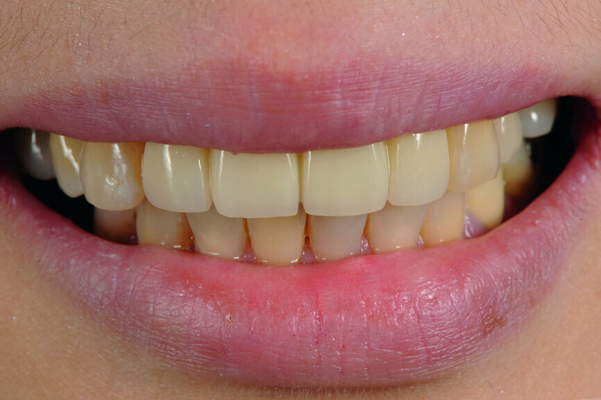 Fig. 19: The patient smiling with the provisional restoration in situ.