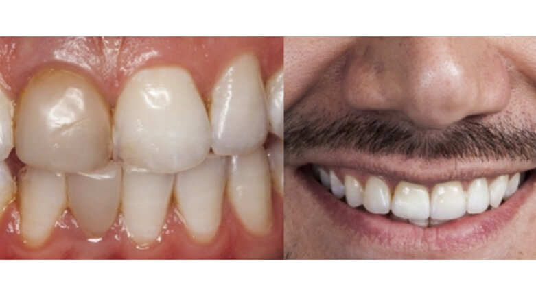 Dinámica lumínica en dientes anteriores con cerámica vítrea