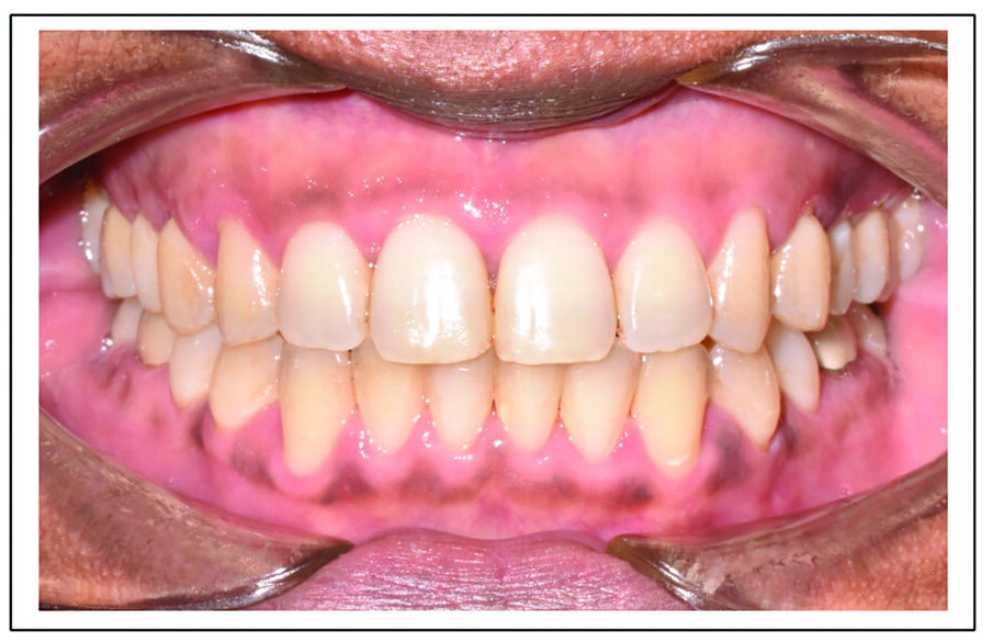 Fig. 13b. Patient S. P. post-treatment after 7.75 months and five appointments of treatment with Spark clear aligners. (Note: Actual patient images, which have not been altered. Patient results may vary.)