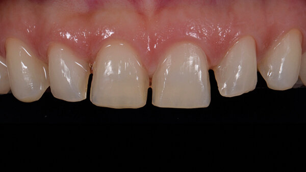 Fig. 9c. Preparación final de los dientes.