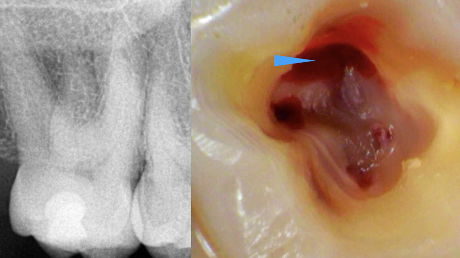 Kliničko lečenje drugog molarnog kanala u maksili u različitim anatomskim situacijama