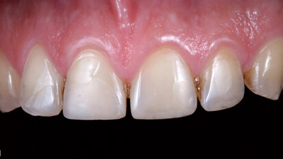 A smile says more than a thousand words: Reconstruction & modification of anterior teeth