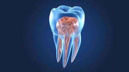 Endodontist highlights tactics to manage complex root canal anatomies