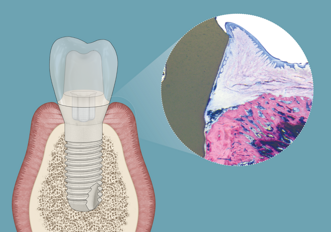 Zircon Medical – Patent Dental Implant System