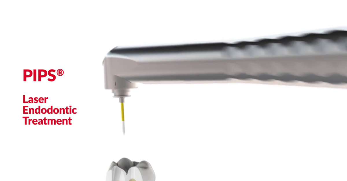 SWEEPS Photoacoustic Endodontics