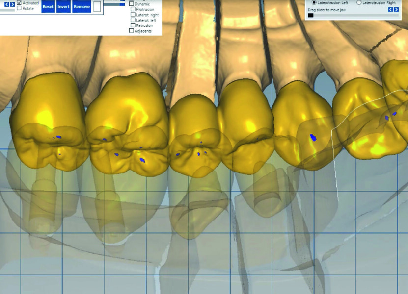 Fig. 5a : Les images 2D et 3D, associées à la conception, constituent la base parfaite pour recréer la situation de la patiente.