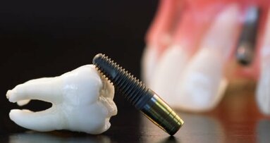 人们往往过分依赖于牙种植体