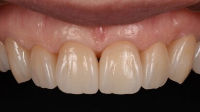 One step closer to nature: Occlusal concepts and sophisticated aesthetics in digital dentistry