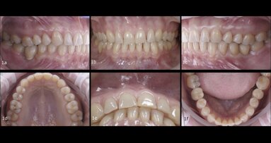 Interdisciplinary treatment of an adult patient with worn anterior teeth
