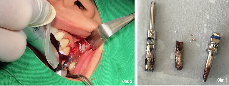 Explantace a okamžitá implantace kombinací reverzního krouticího momentu a trepanační frézy