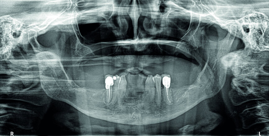 Cas 1 a :  Implantation totale maxillaire 45 jours après avoir réalisé une ostéoactivation.