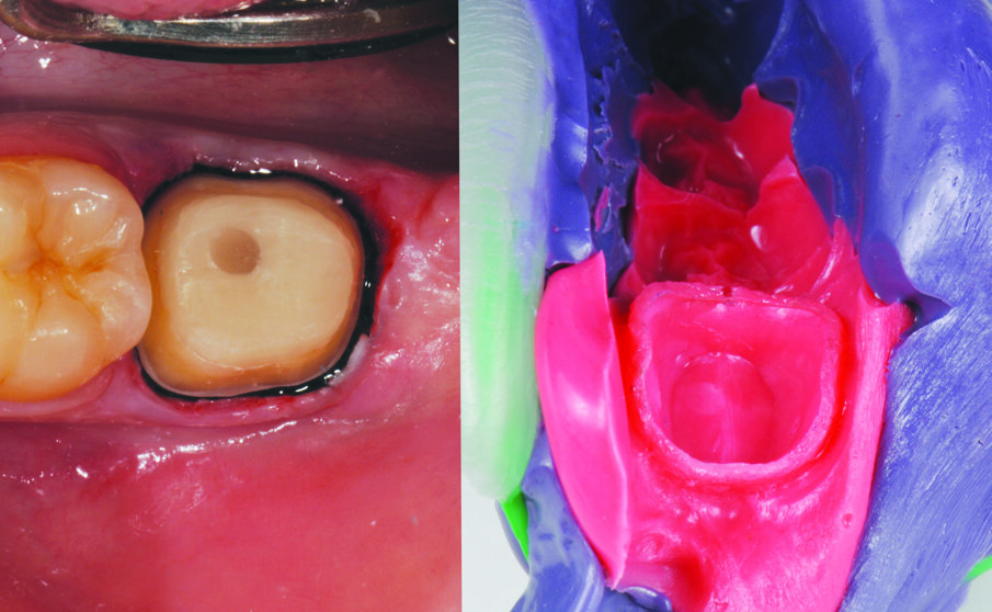 Fig. 2: Tooth preparation after post placement and core build up with a low shrink composite. Retraction in place. Impression with polyether impression materials.