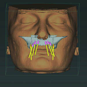Fig-5-Analyse-dento-faciale-du-traitement-implantaire-proposé-dans-l’arcade-maxillaire-300x300-