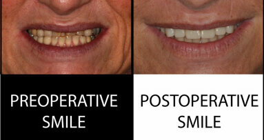 All-ceramic rehabilitation with CAD/CAM restorations made of a zirconia–reinforced lithium silicate