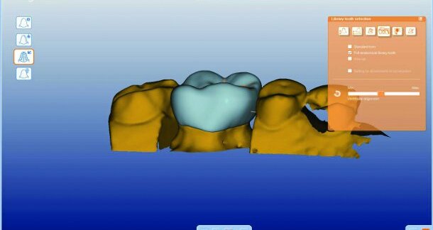 CAD/CAM-fabricated lingual retainers made of nitinol