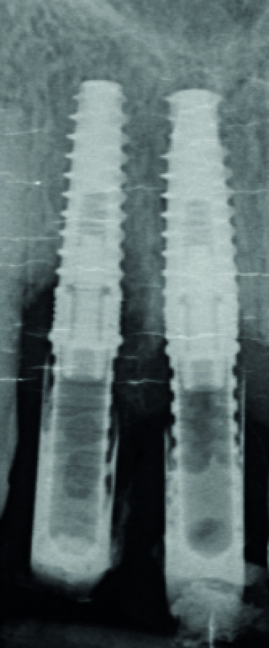 Fig. 7 : Radiographie « long-cône » postopératoire. Notez l’image résiduelle de l’alvéole au niveau de l’implant en 12.