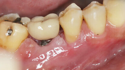 Periimplantitis - druga najčešća komplikacija nakon terapije dentalnim implantatima
