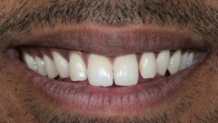 Smile makeover with composite veneers using injection moulding - Dr. Stephen D'souza
