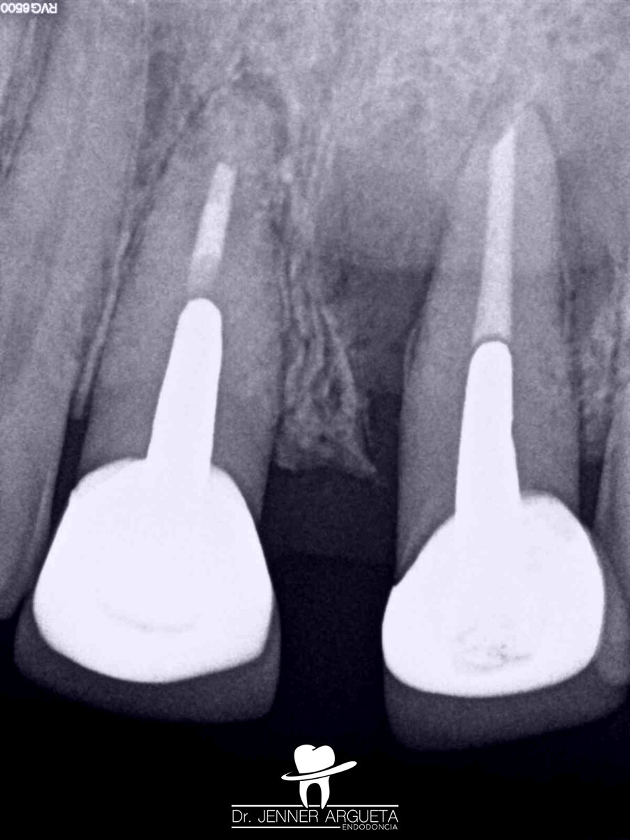 Fig. 9: Initial radiograph of teeth #11 and 21. Radiolucent areas in both teeth were visible, and cemental tears were present in tooth #21.