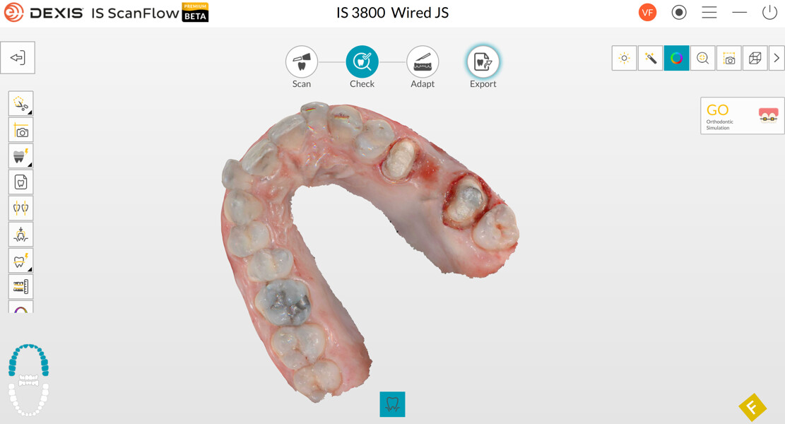 Figs. 3a–d: Digital impression taking with the DEXIS IS 3800 intra-oral scanner.
