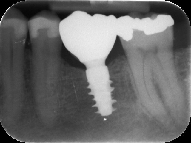 Fig. 19: Radiograph confirming the correct seating of the final crown—no gap visible.