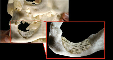 Scientists from Norway develop scaffolding to repair severe teeth and jawbone defects