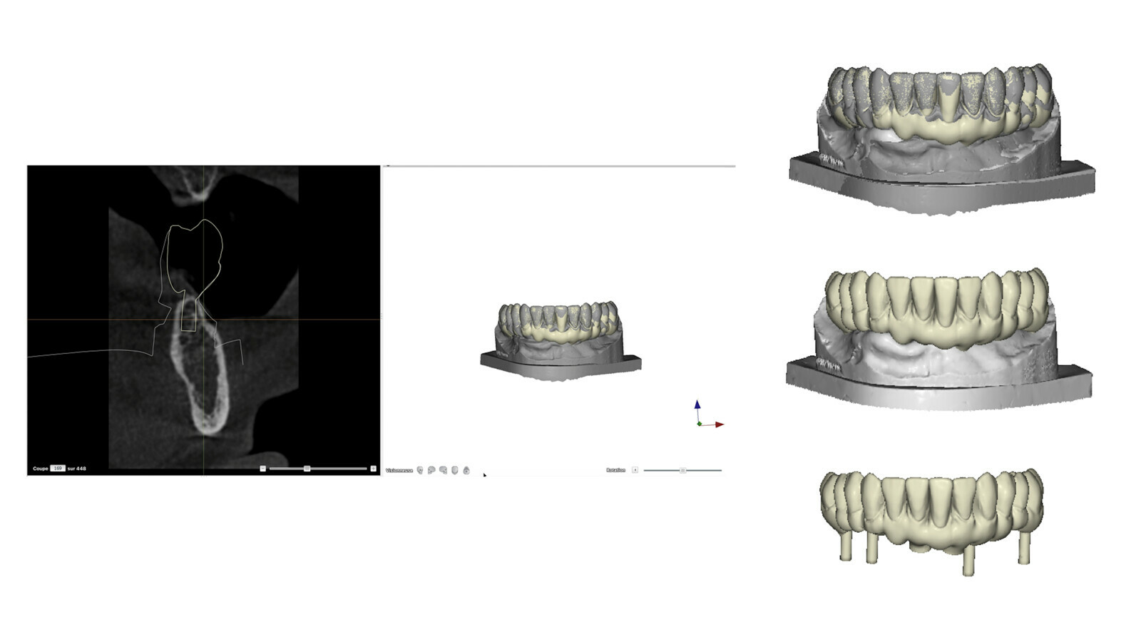 Implant treatment of the fully edentulous patient