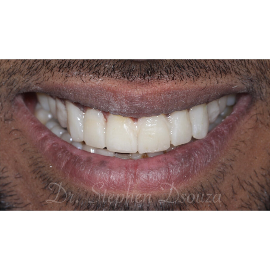 Fig. 4 Mockup transfer frontal smile