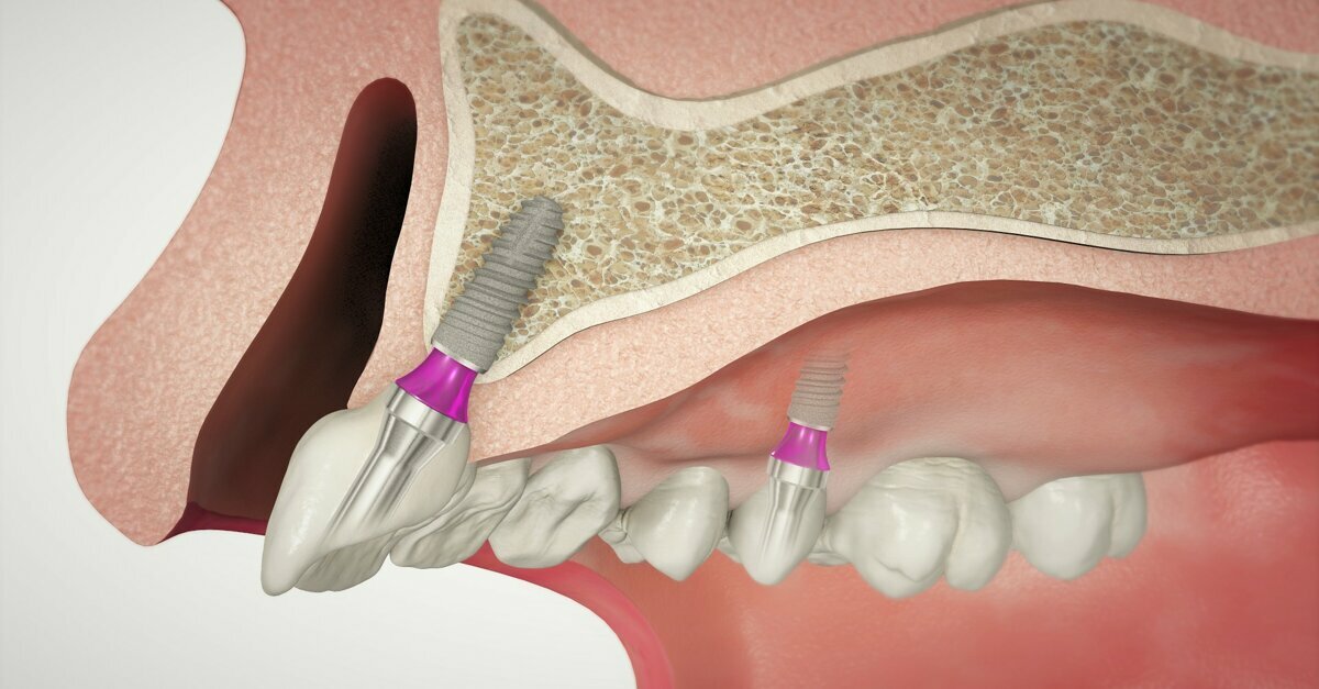 DT News - UK - How the SKY fast & fixed implant system lives up to its name