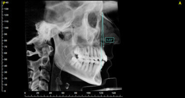 Ruolo della posizione degli incisivi nella preparazione ortodontica pre-chirurgica