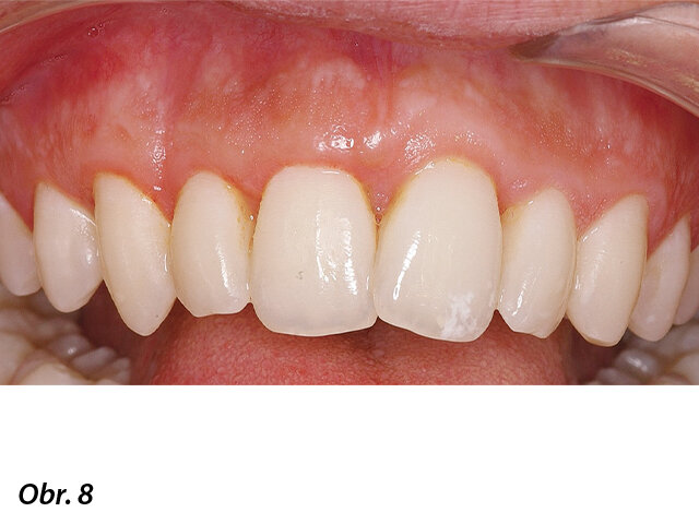 Zhojené, zdravé gingivální tkáně, barevně homogenní. Pacient připravený na ortodontickou léčbu.