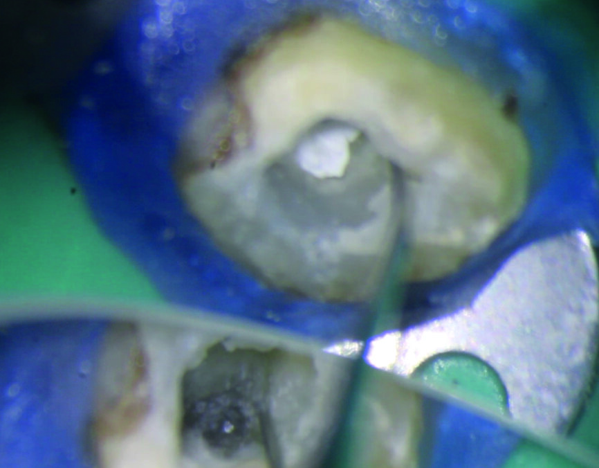 Figs. 7a et b : Création d’un espace autour du segment coronaire de l’instrument fracturé avec SONICflex Quick 2008 L muni d’un insert Endo Clean de taille 25.