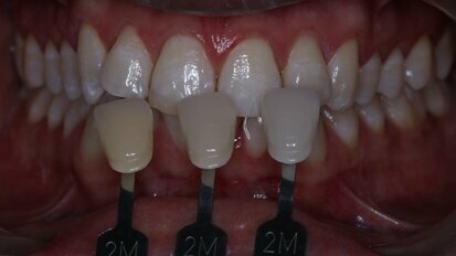 A less destructive method to whiten teeth developed in China