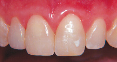 Biomimetic principles applied to cosmetic dentistry