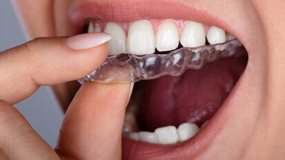 American Dental Association voices concerns around do-it-yourself aligners