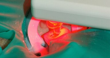 New Technologies—to improve root canal disinfection
