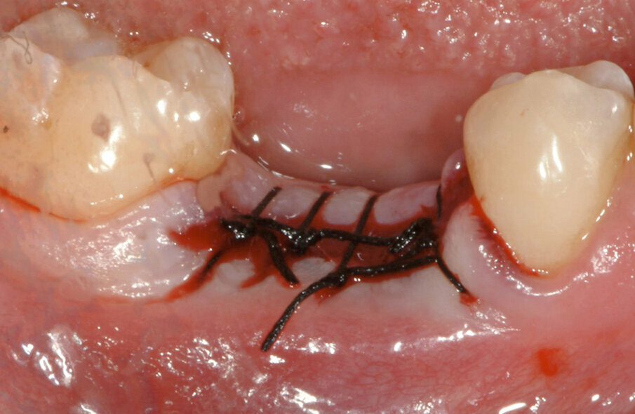 Fig. 3: Tooth extraction
was performed without damaging the alveolar walls. The socket was scraped and sutured without using grafting material.