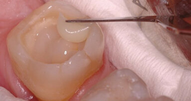 Primena različitih tipova kompozitnih materijala u direktnoj privremenoj restauraciji zuba - prikaz slučaja