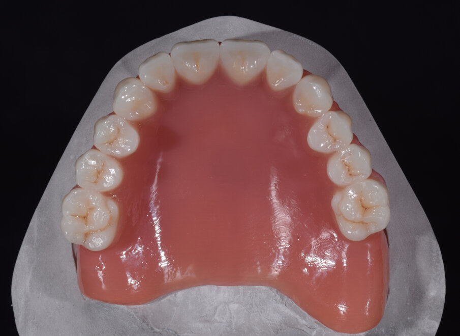 Fig. 20: Individualisation of the occlusal surfaces of the maxillary denture with composite stains (FinalTouch).