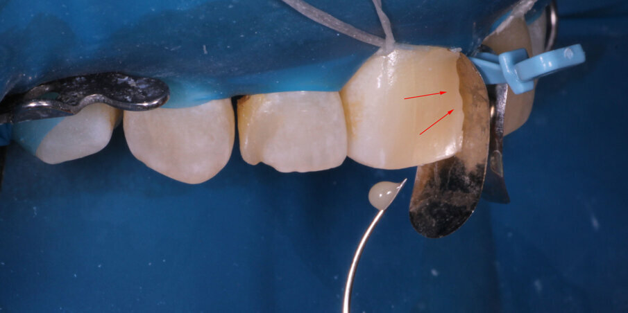 Fig 9. A small drop of flowable placed first to ensure wetting of the next mass of composite.Marked arrow indicating area where excess will flow out once packed from palatal aspect