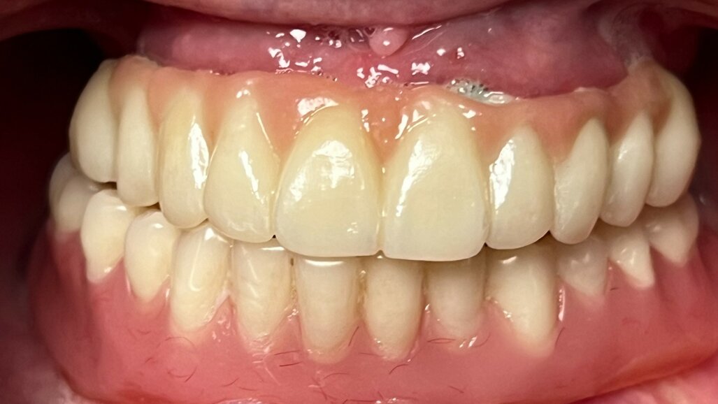 Trattamenti con dentizione terminale in età pre-geriatrica: proposta di un protocollo clinico di Day Dentistry