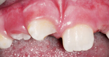 Endodontické ošetření zubů s nedokončeným vývojem kořene