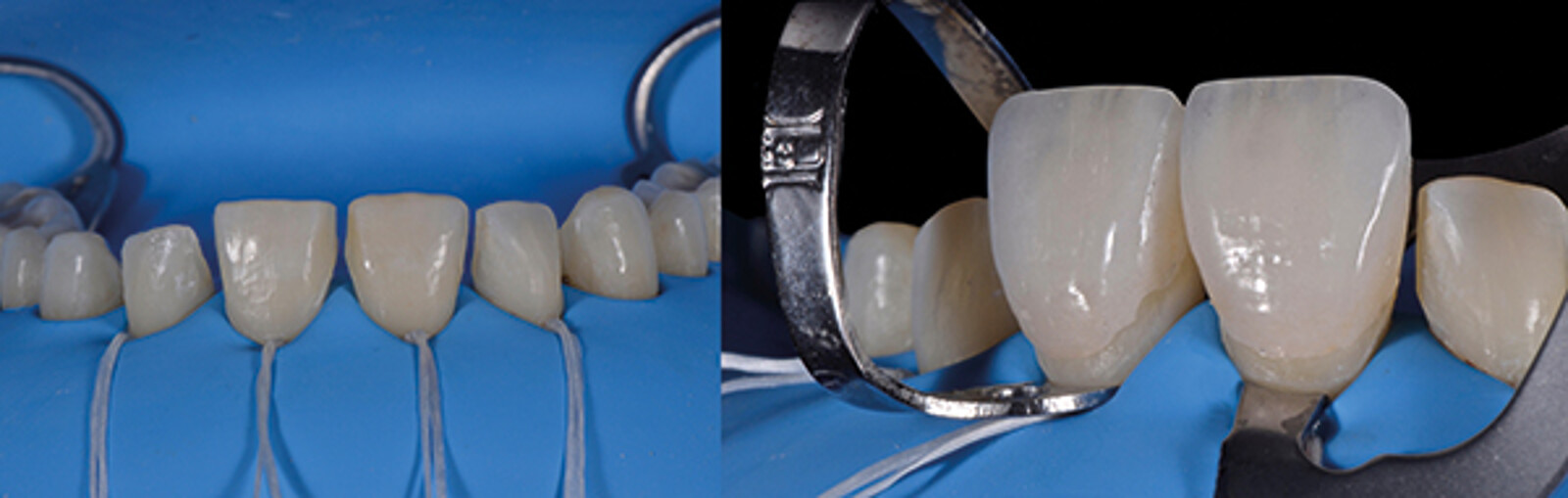 Fig. 16a. Aislamiento y prueba del ajuste de las carillas en los dientes # 11 y 21.